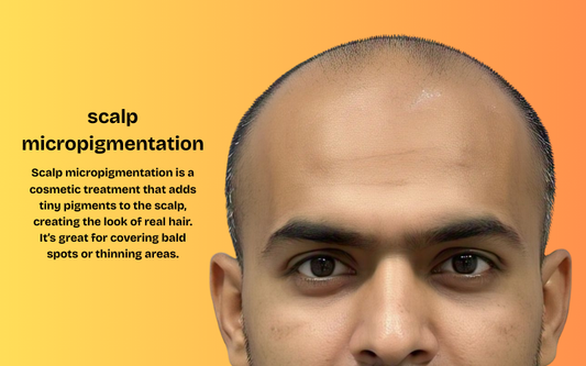 Scalp Micropigmentation Treatment for Hair Loss in Dubai